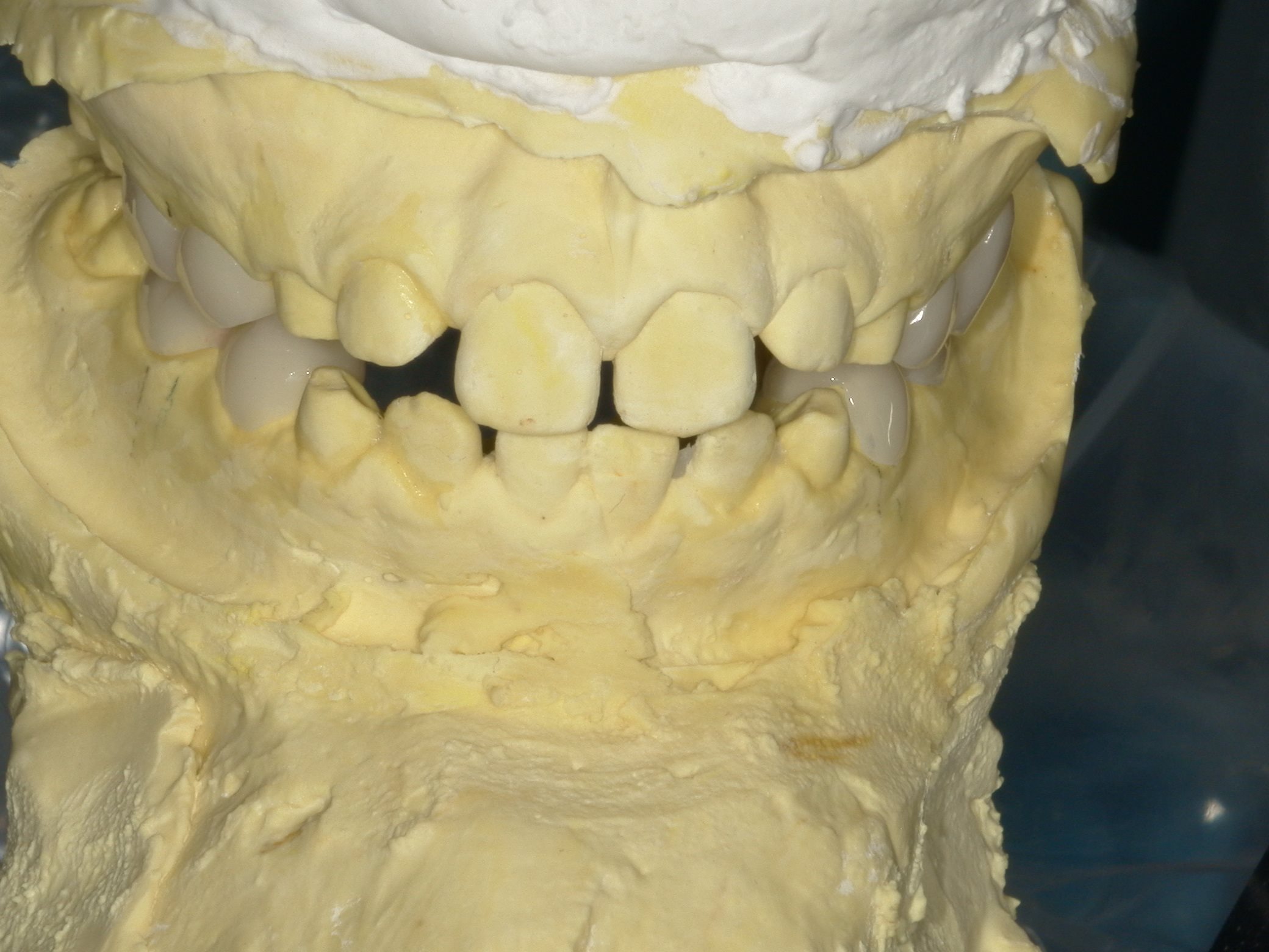 小児オーバーレイ治療