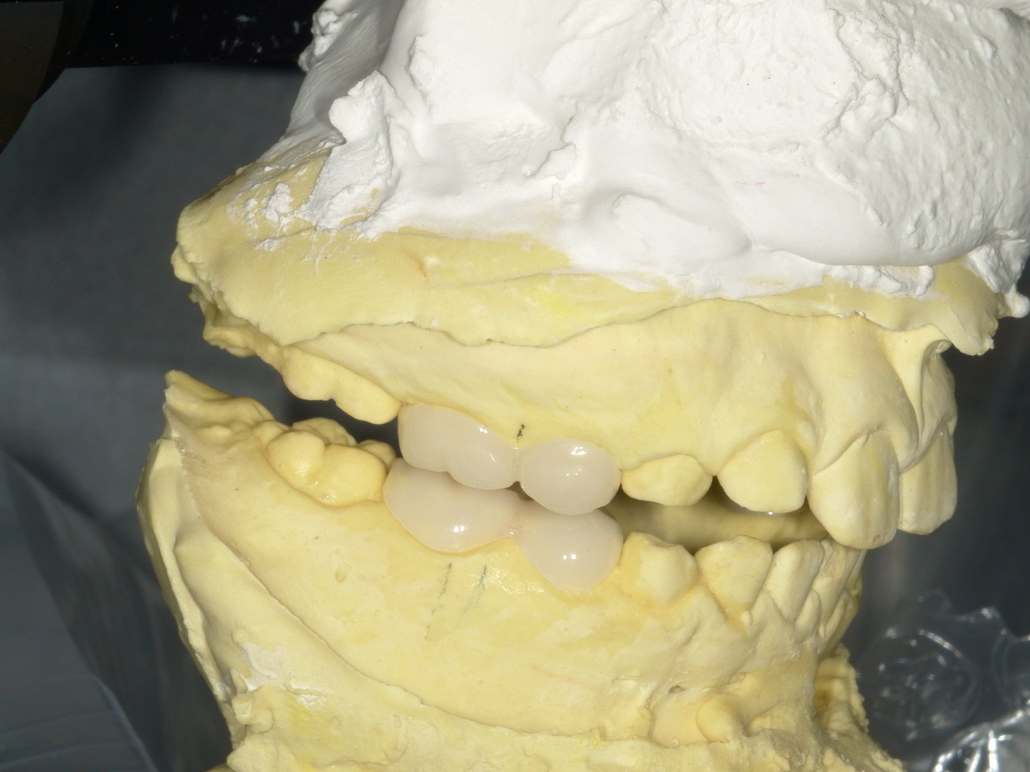 小児オーバーレイ治療